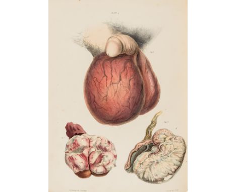 Andrology.- Pott (Percivall) Practical Remarks on the Hydrocele or Watry Rupture, and some other Diseases of the Testicle...,