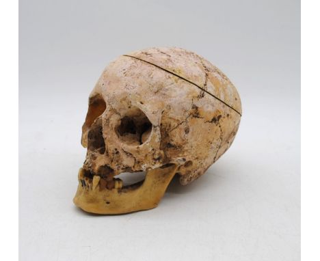 A human skull, with some replacement resin parts and blunt force trauma suffered to the back- used as teaching aid at Kings C