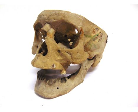 A COLLECTION OF MEDICAL EQUIPMENT comprising a human skull (lacking cranium); Allen &amp; Hanbury's auroscope; Accoson sphygm
