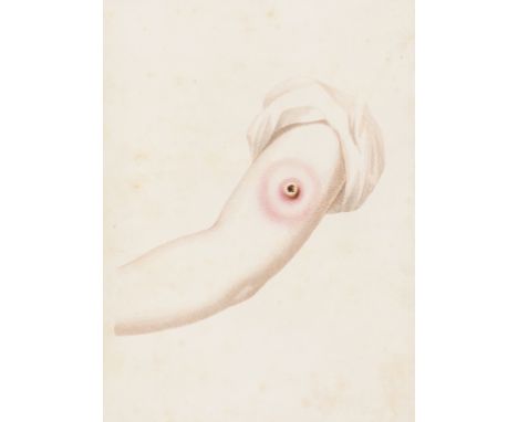 Jenner (Edward) An Inquiry into the Causes and Effects of the Variolae Vaccinae, a Disease discovered in some of the Western 