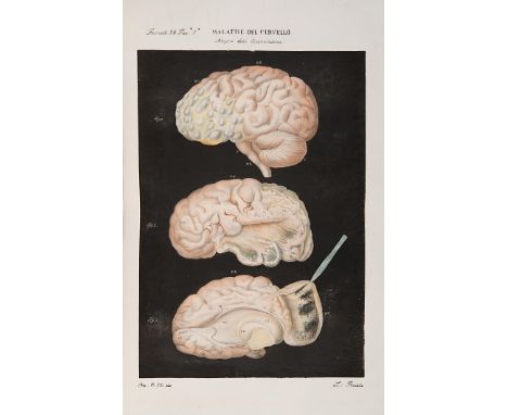  Cruveilhier, Jean. Atlante generale della anatomia patologica del corpo umano. Firenze, Vincenzo Batelli, 1843. In 2° (462 x