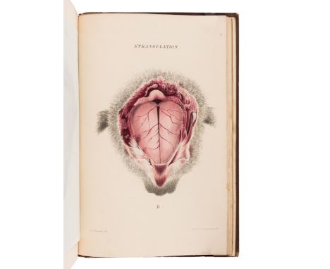 BURROWS, George (1832-1909). On Disorders of the Cerebral Circulation; And on the Connection between Affections of the Brain 