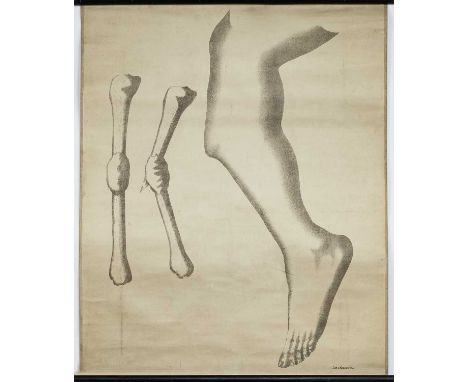 19TH CENTURY MEDICAL ROLLER CHART DEPICTING A FRACTURED TIBIA  c. 1890, by Lith v. Handorff Kiel69cm x 50cm 