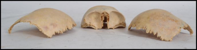 A 19th century Victorian medical school human child skull separated into three pieces, two skull