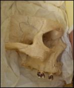 A 19th century Victorian anatomical  medical school sample skull right eye socket with jaw bone