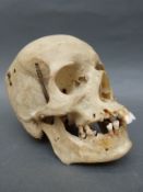 A male human skull labelled with anatomical regions, with articulating jaw and removable top.