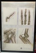 Human bone dislocation Stunning Vintage Large Framed chart 1930c