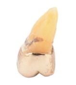 GOLD CROWN AFFIXED TO TOOTH