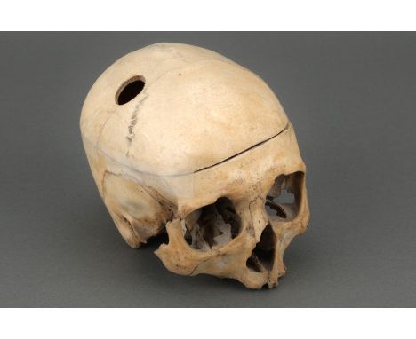 Victorian Human Skull Showing Surgery Victorian Human Skull from a private medical collection showing a trephine hole at the 