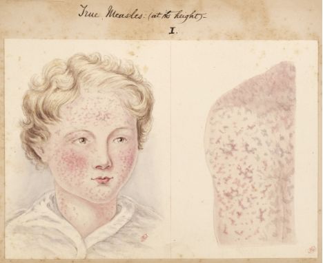 Measles Manuscript. Essay on Measles, German Measles, and their counterfeits, [manuscript submitted for the Boylston Prize of